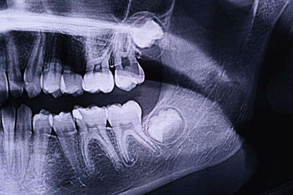 wisdom tooth decay infection