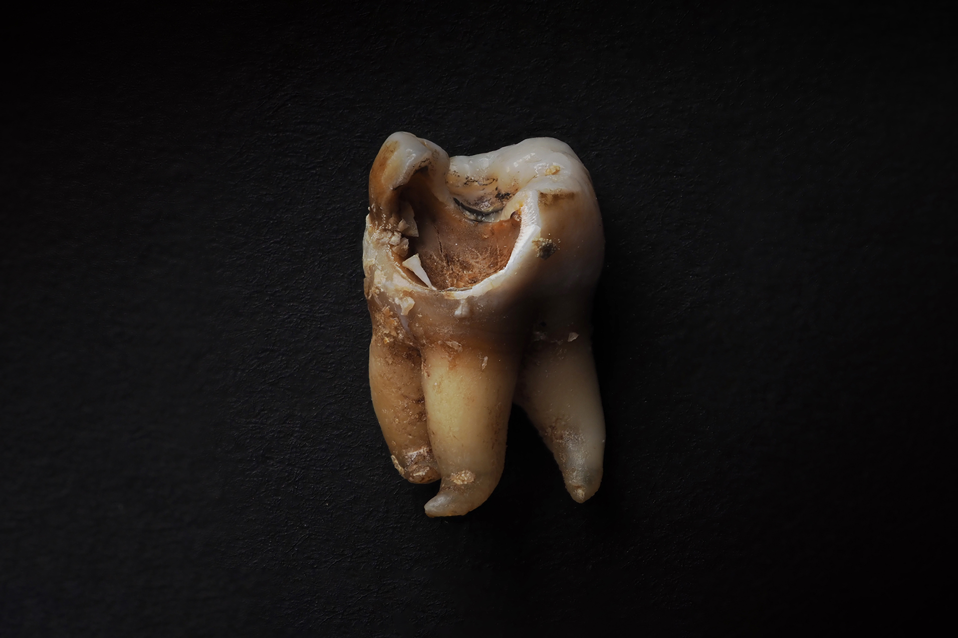 wisdom tooth decay