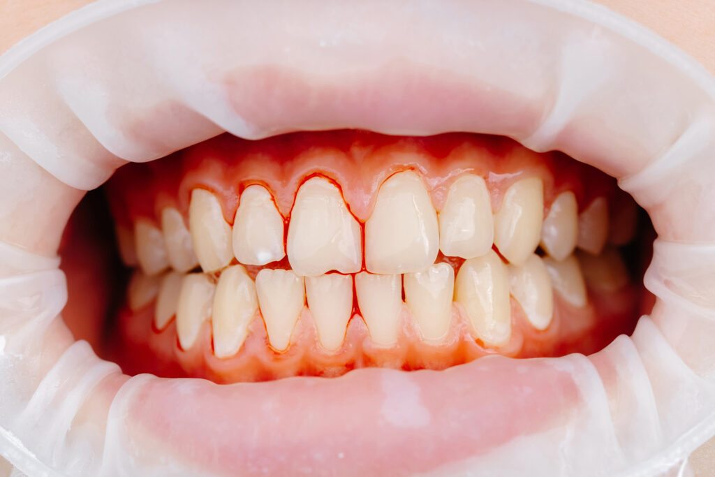 healthy gums vs gingivitis