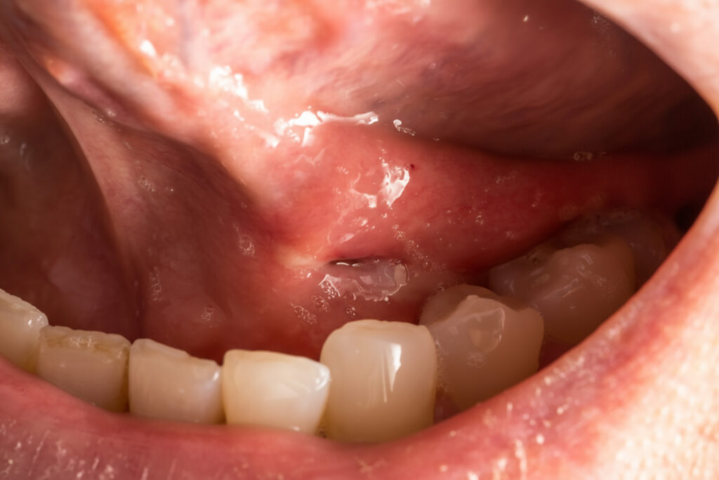 what causes pericoronitis