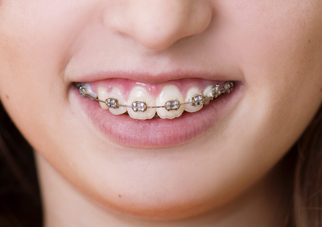 best braces for kids