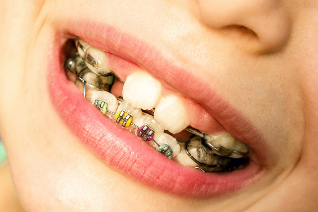 clear braces for kids in Singapore