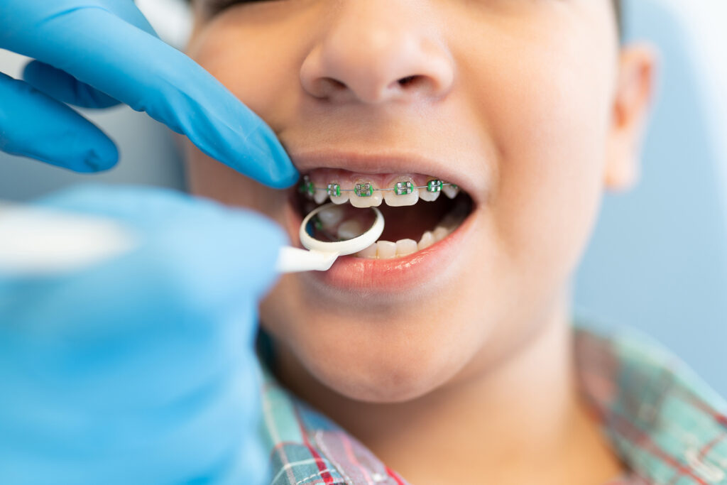 early orthodontic treatment in Singapore