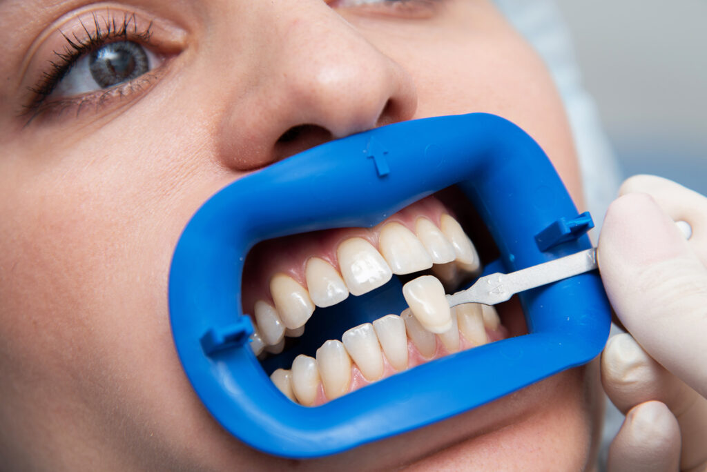 porcelain vs composite veneer