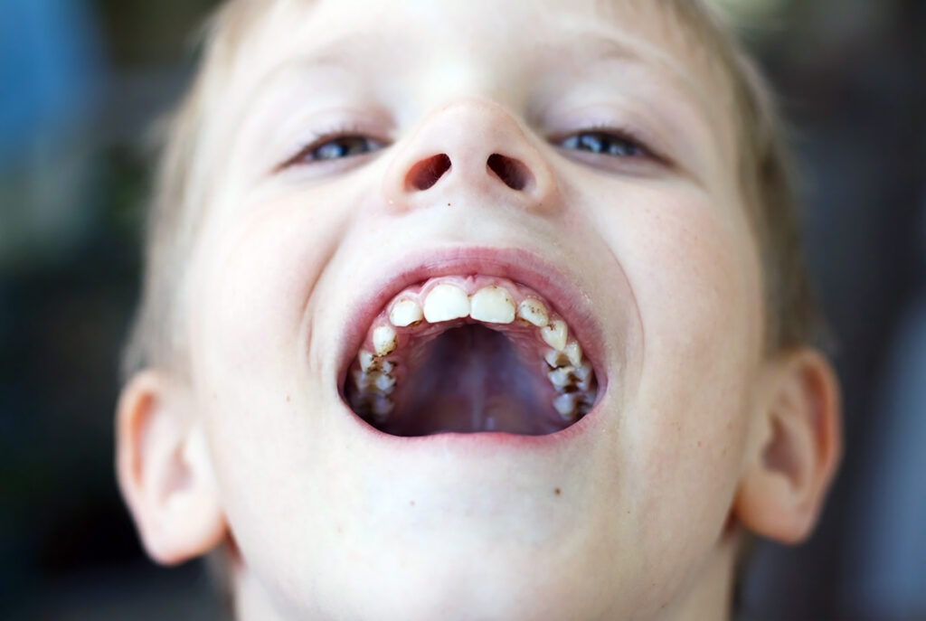 can front teeth get cavities