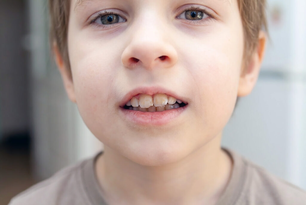 cavity front teeth children