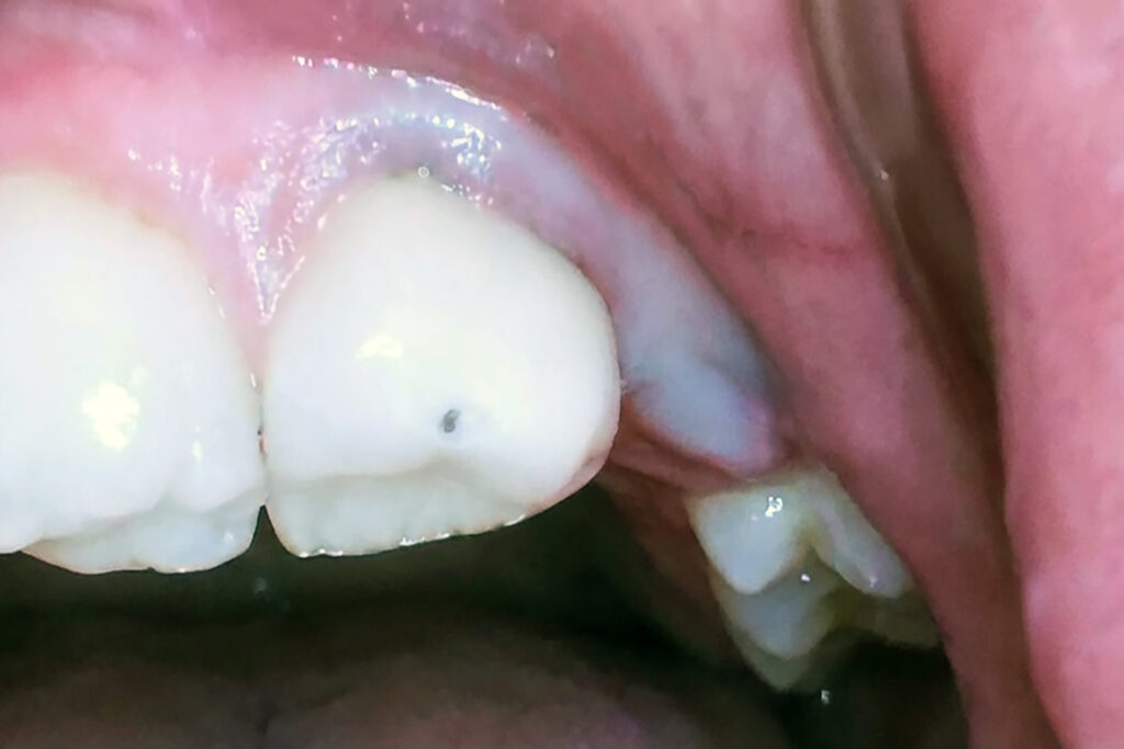 gum swollen over growing wisdom tooth