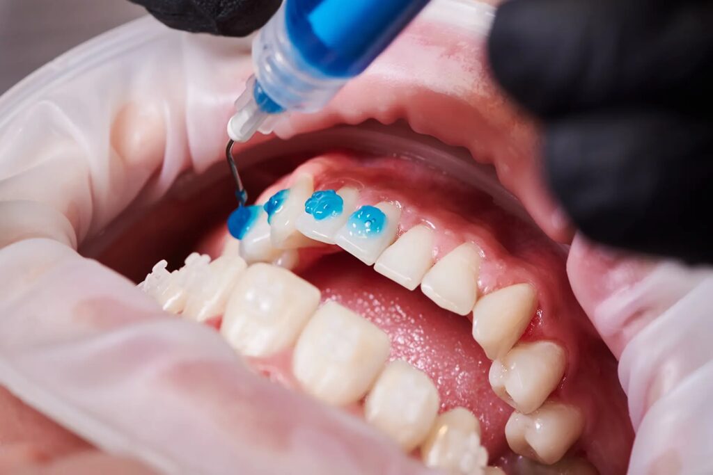 LED teeth whitening cost