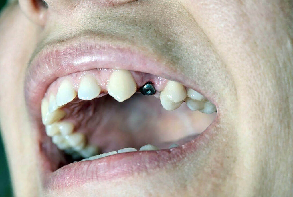 cost of root canal and crown vs implant