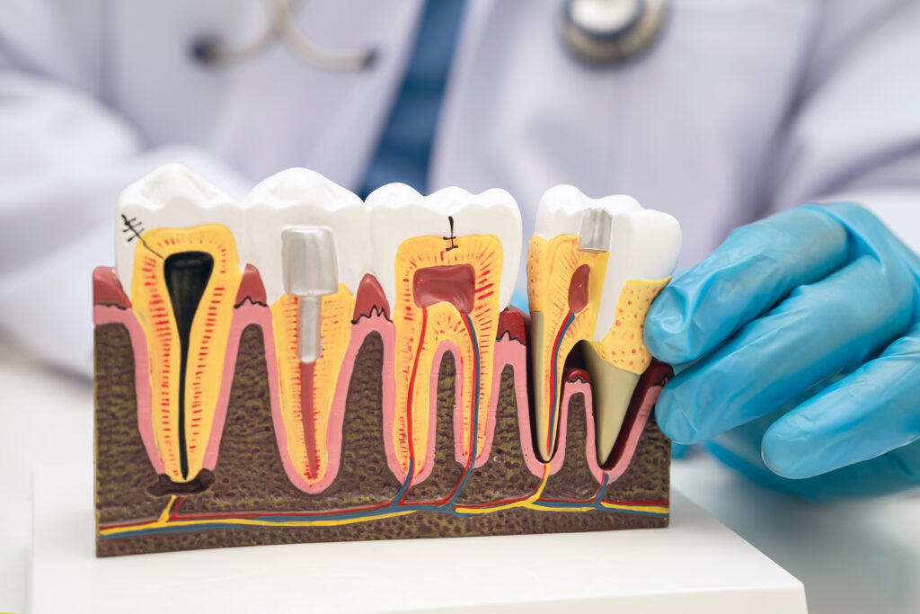 dental implant vs root canal