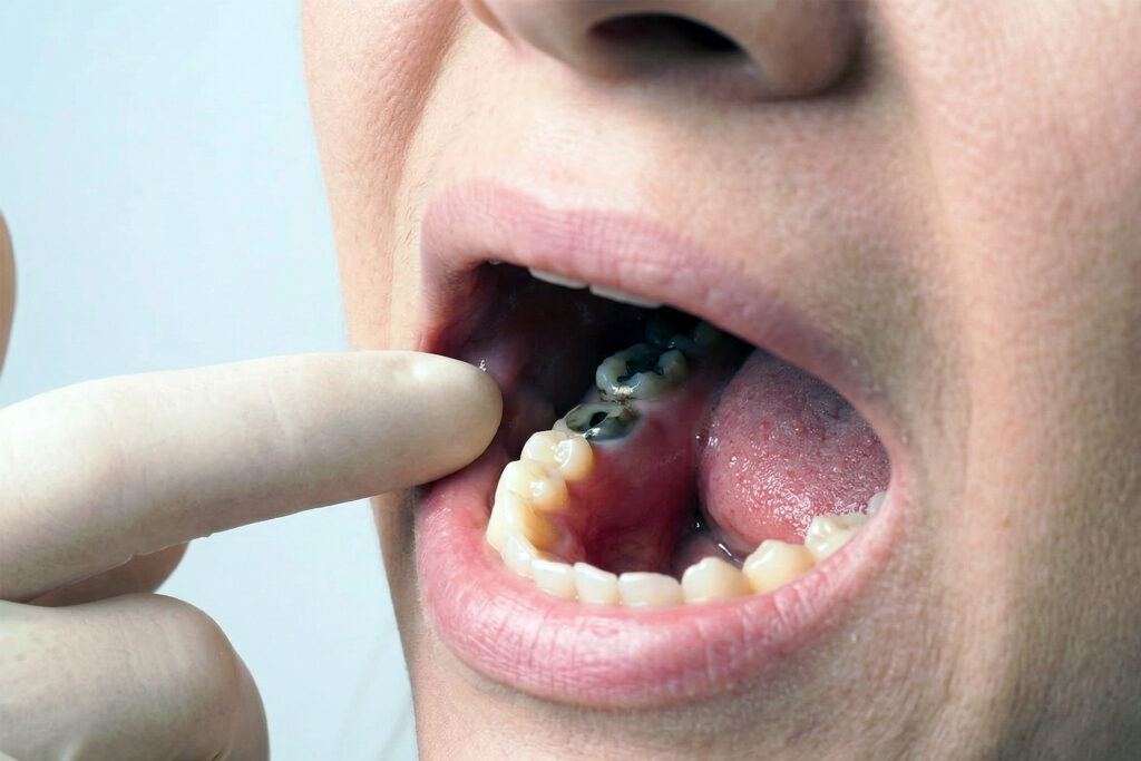 molar root canal without crown