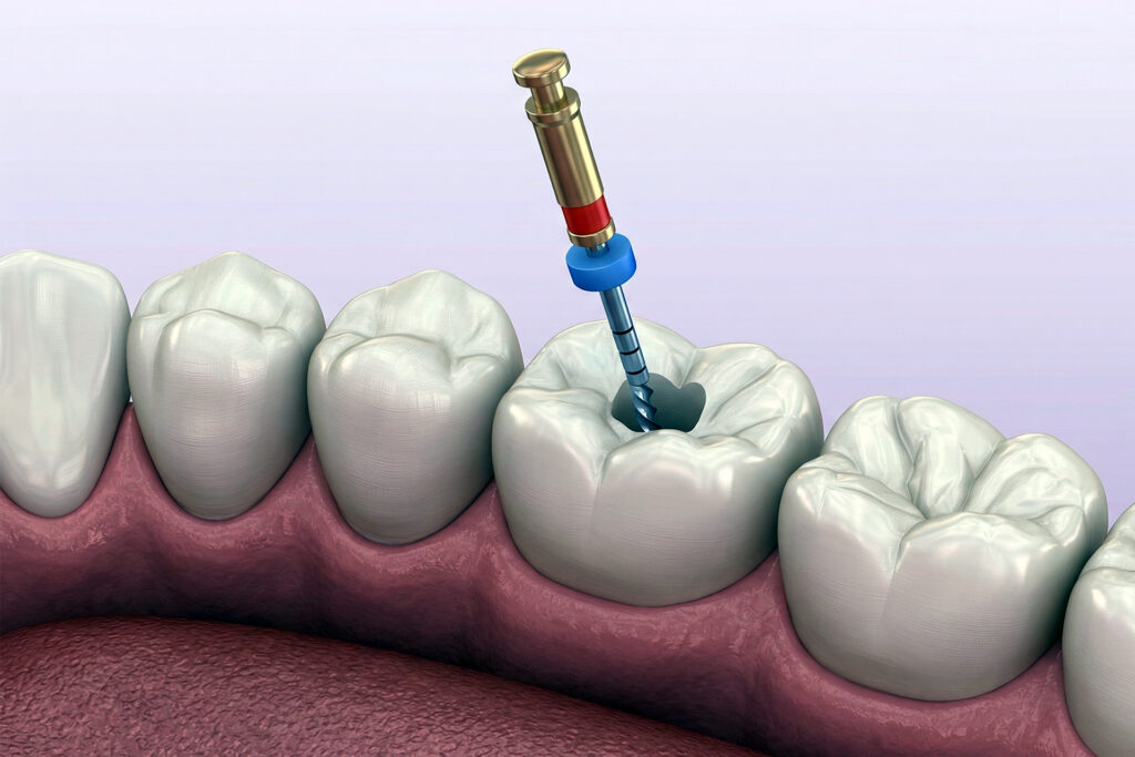 root canal treatment without crown