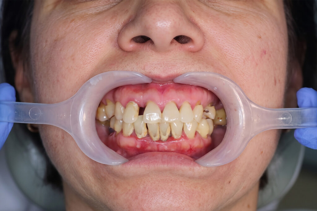 advanced periodontitis