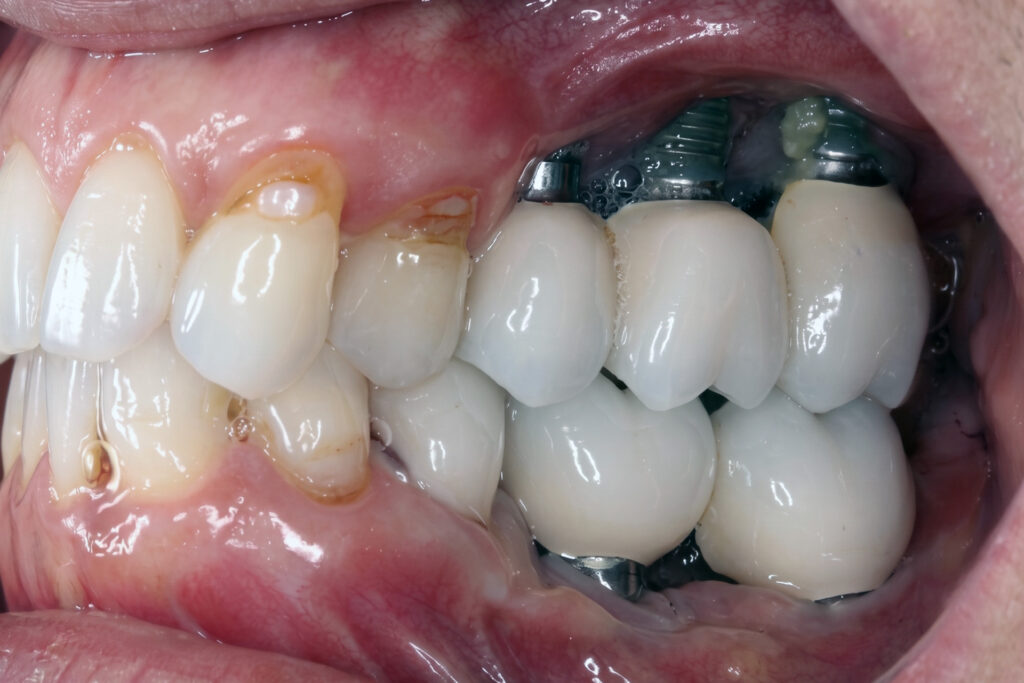 dental implants with periodontal disease Singapore