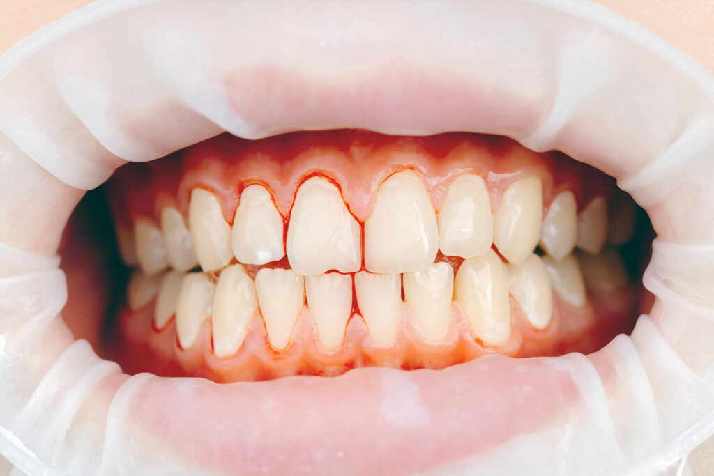 dental implants with periodontal disease symptoms