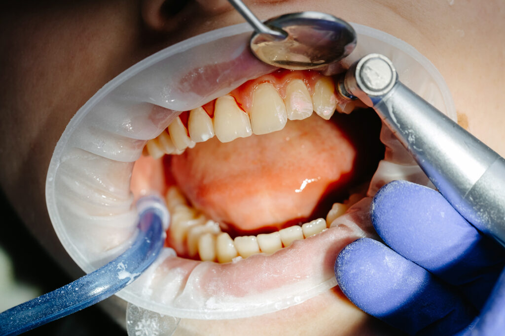 dental implants with periodontal disease treatment