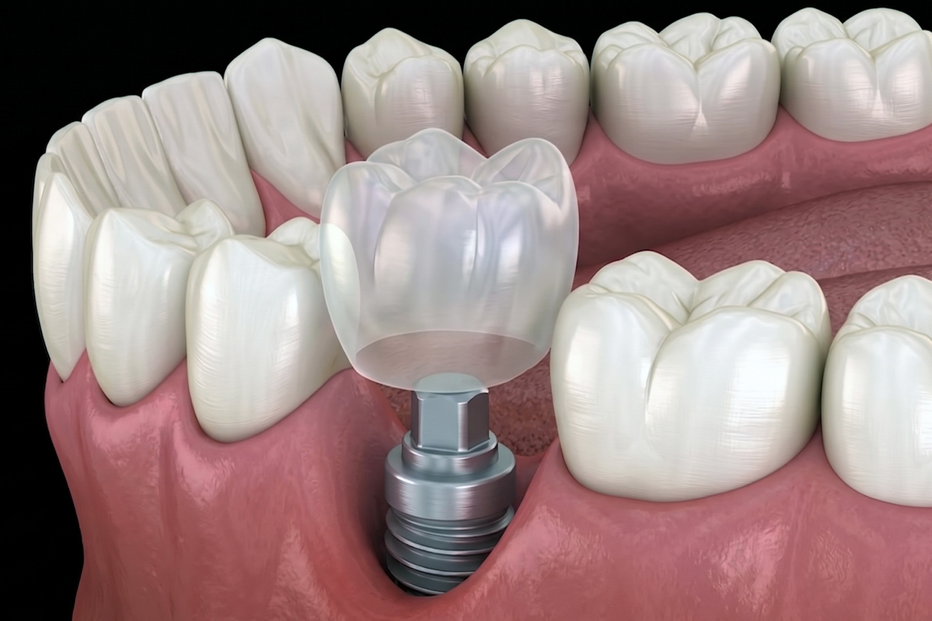 dental implants with periodontal disease