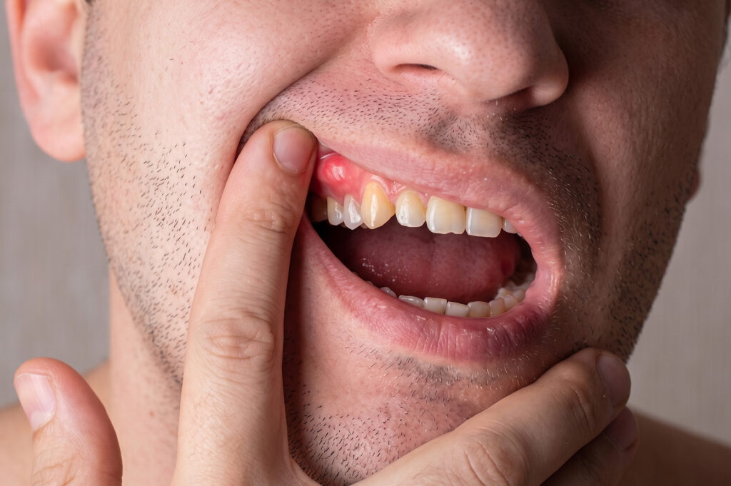 gingival hyperplasia symptoms
