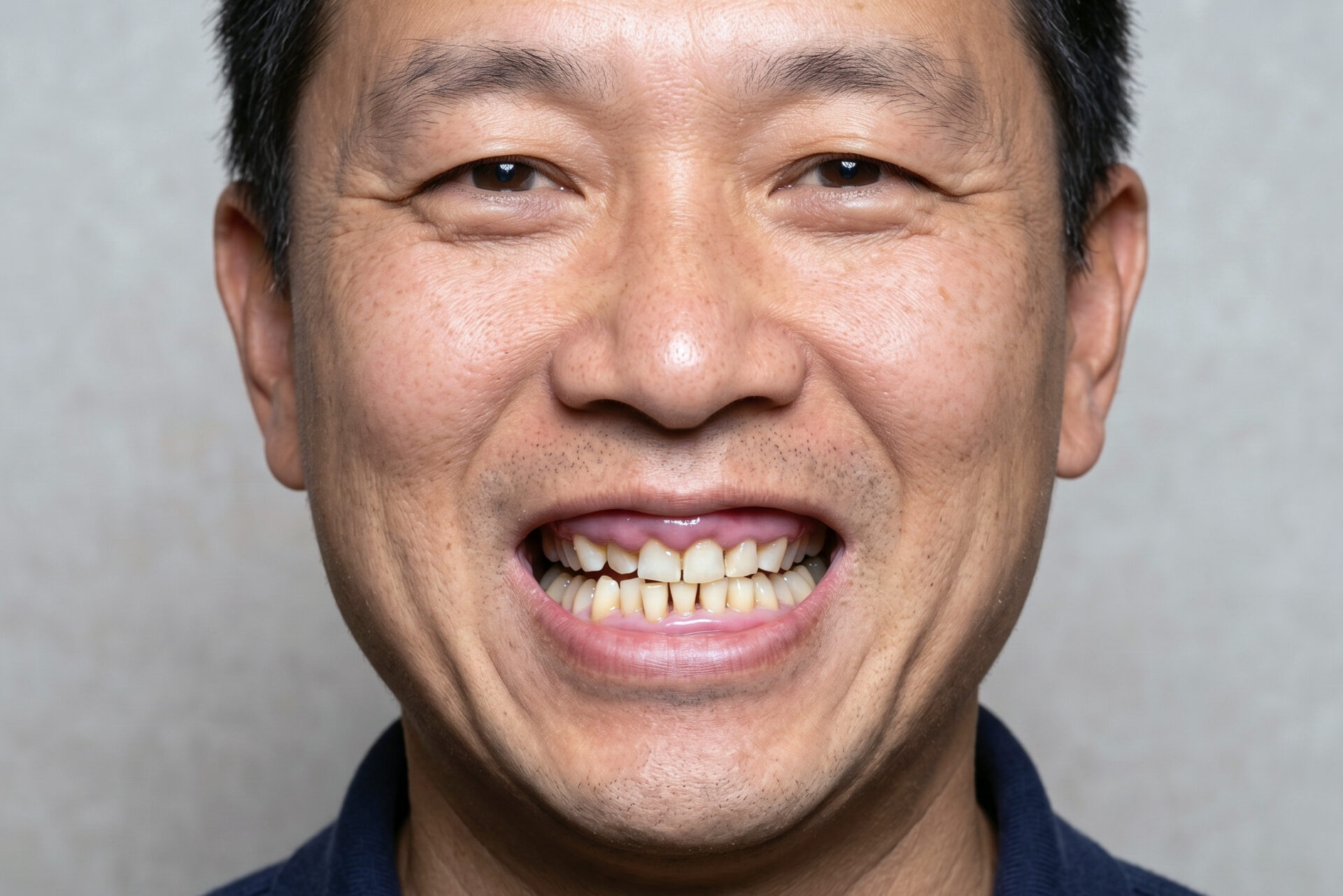 gingival hyperplasia
