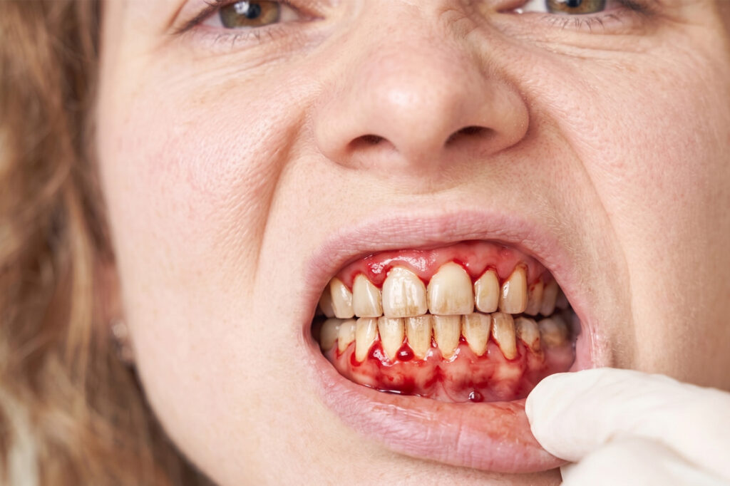 periodontal disease vs gingivitis