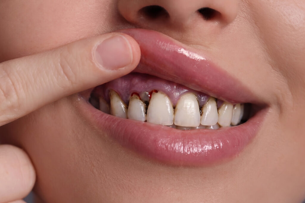 periodontal disease vs gingivitis in Singapore