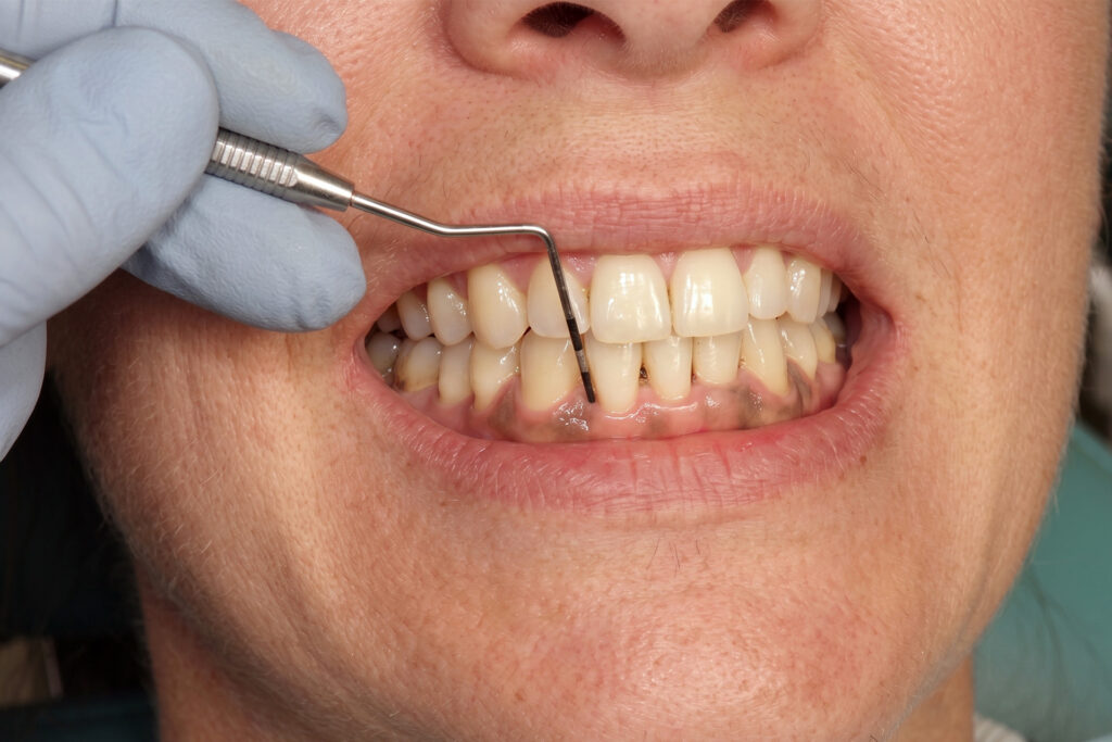 periodontal pocket