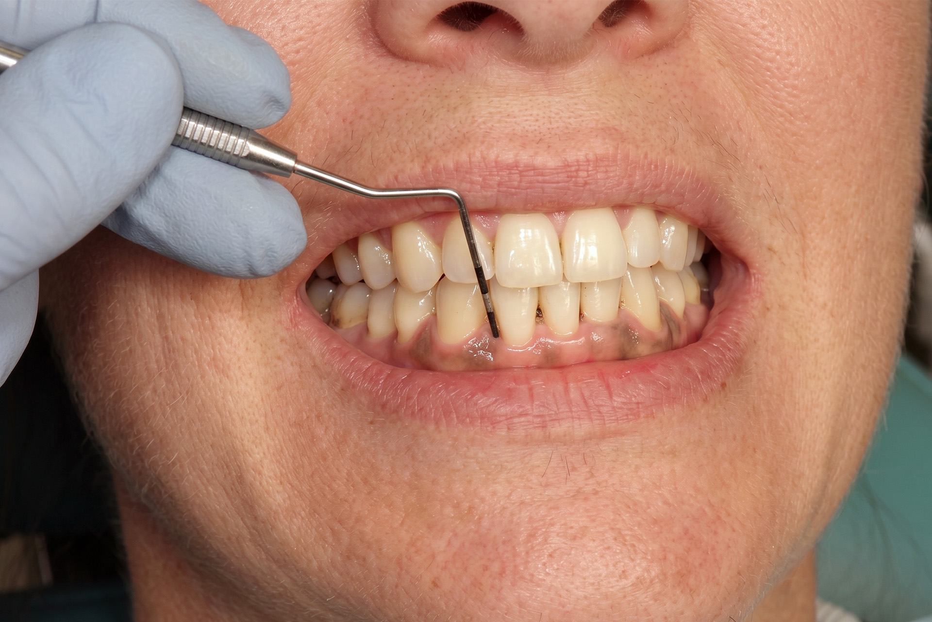 periodontal pocket