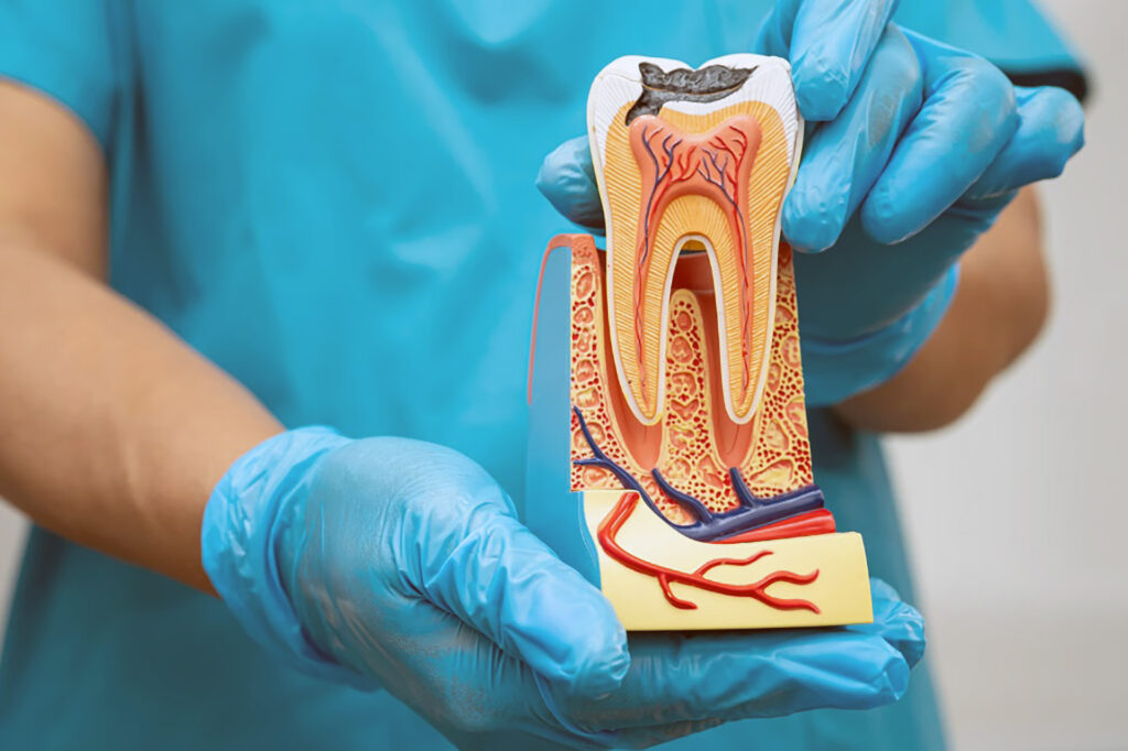 root canal pain relief