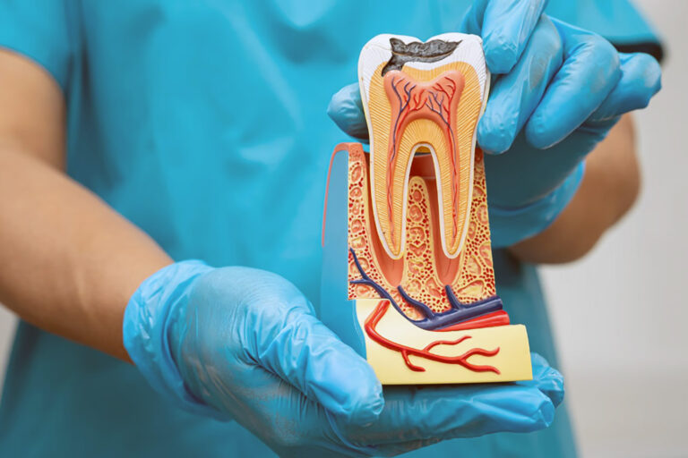 root canal pain relief