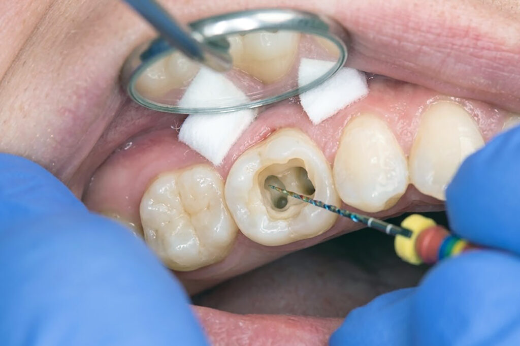 root canal treatment side effects in Singapore