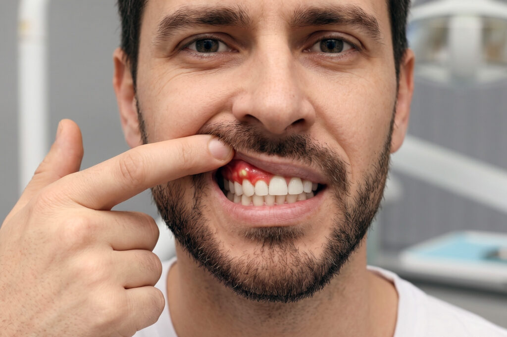 abscess gum infection