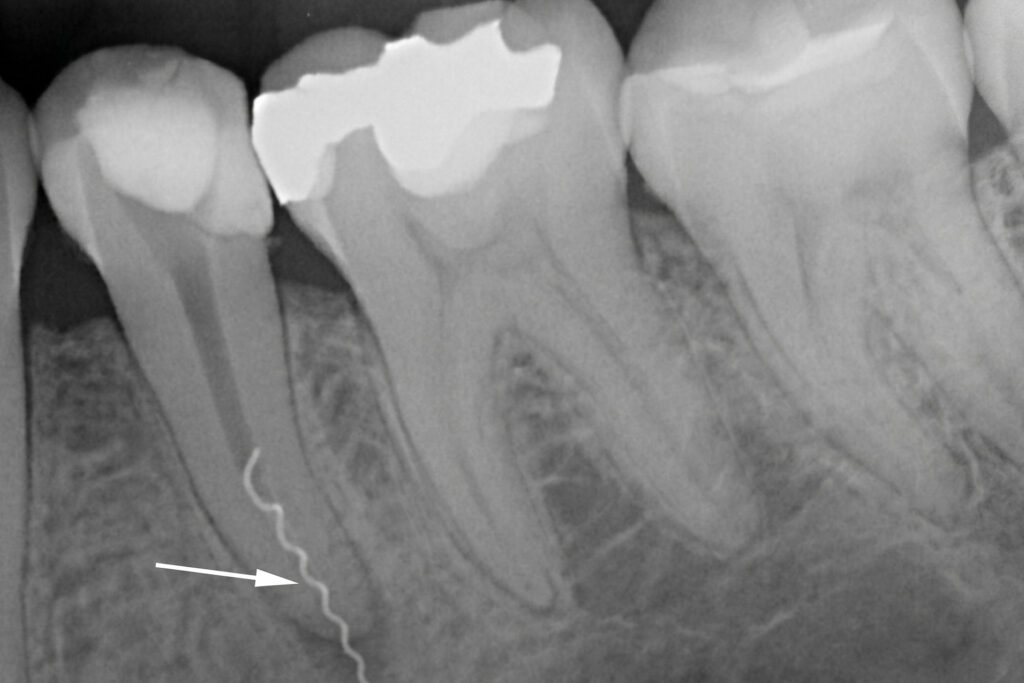 acute apical periodontitis