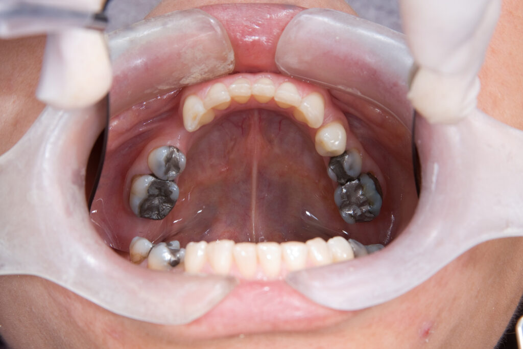 amalgam filling cost