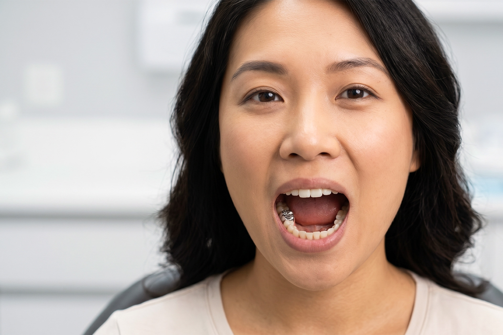 amalgam fillings
