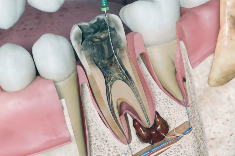 apical periodontitis