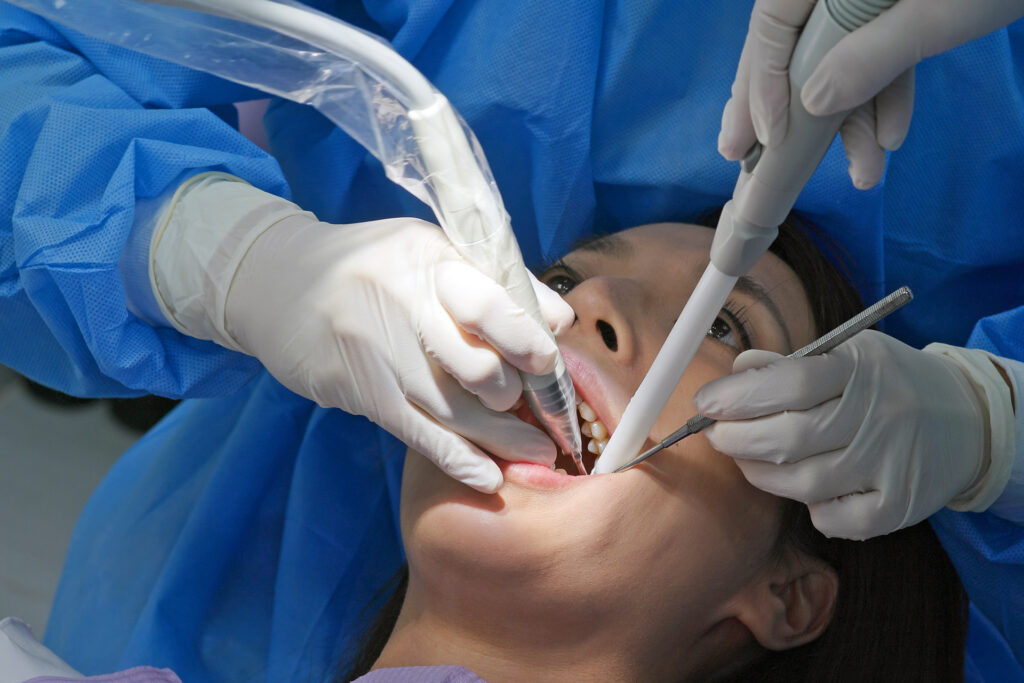 dental root planing