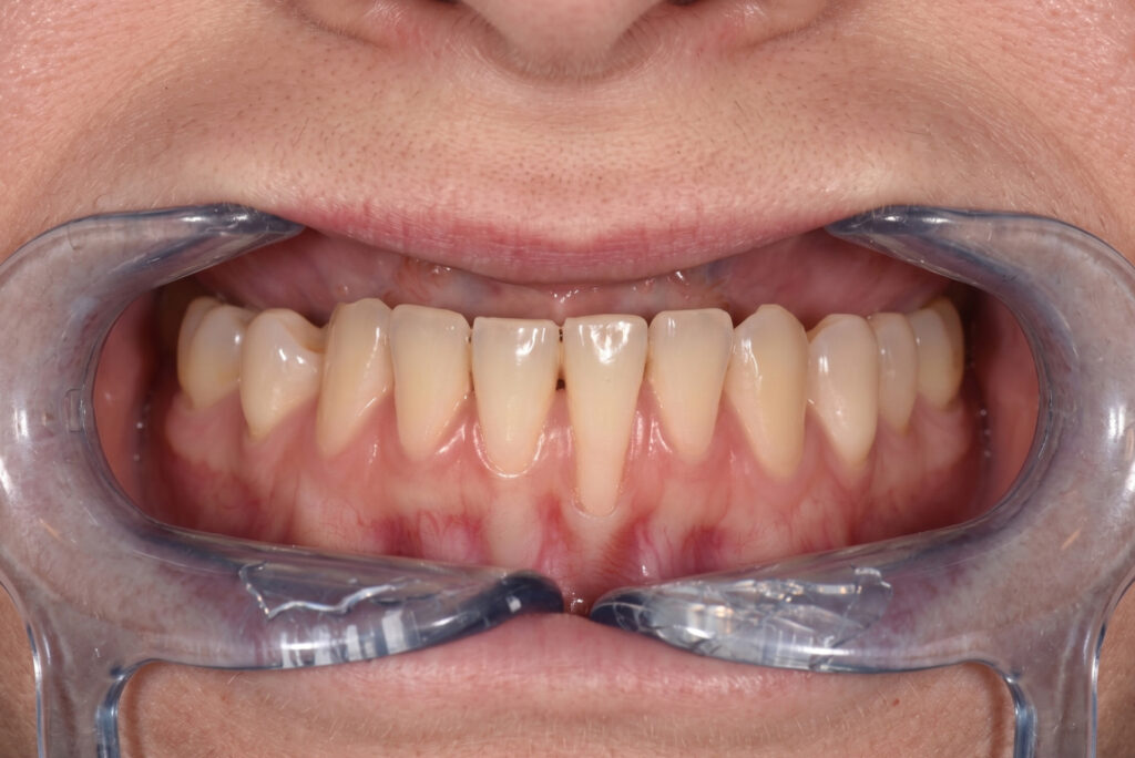 gum recession