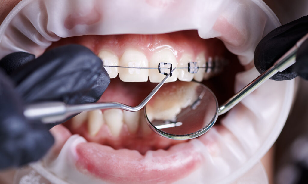 how to prevent receding gums