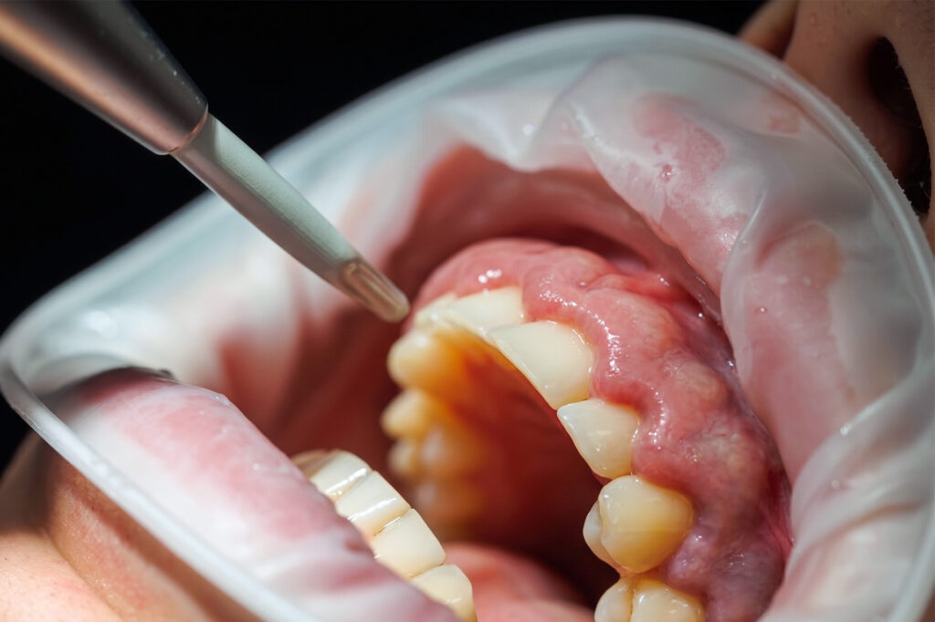 painful swollen gums