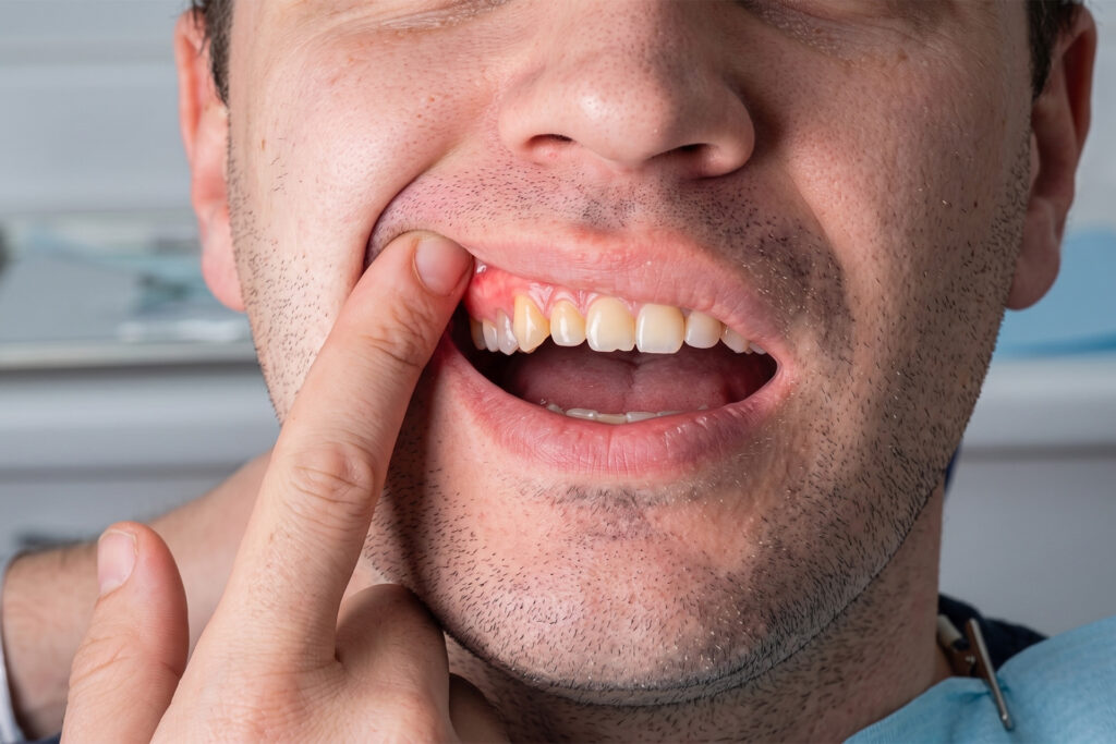 periodontal abscess