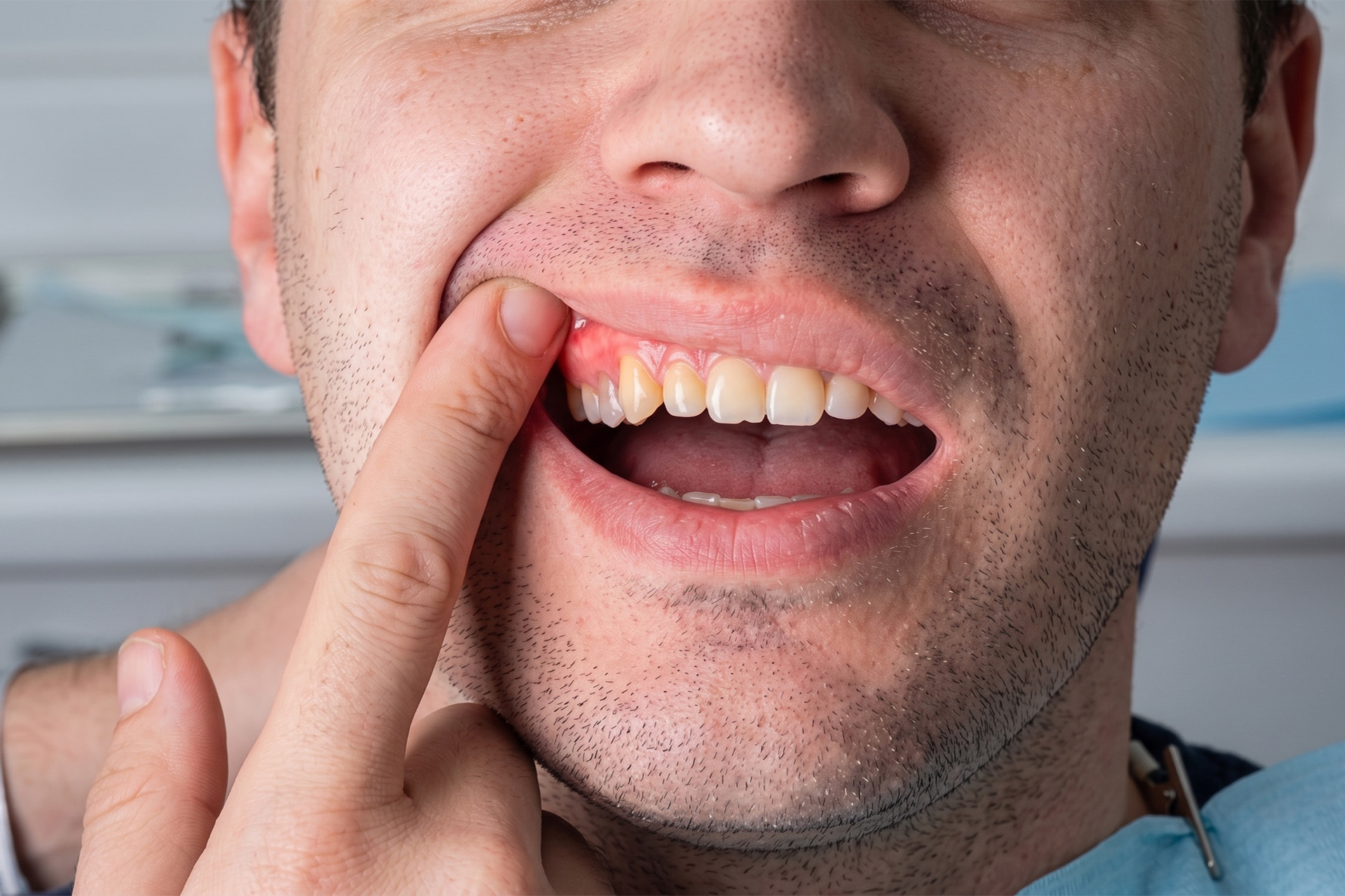 periodontal abscess