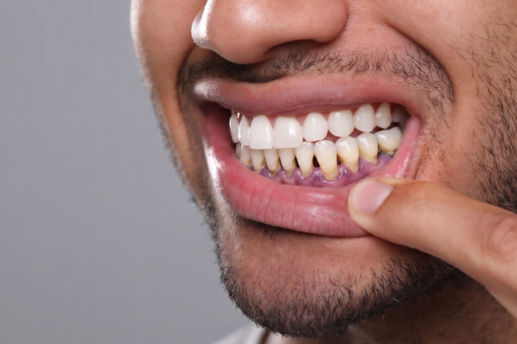receding gums