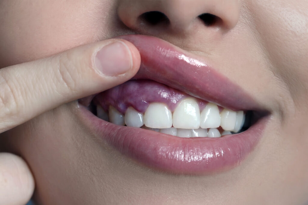 swollen gums