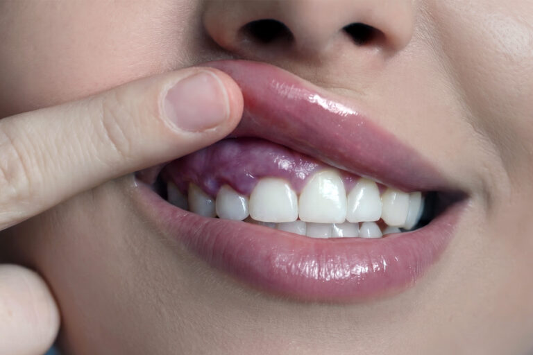 swollen gums