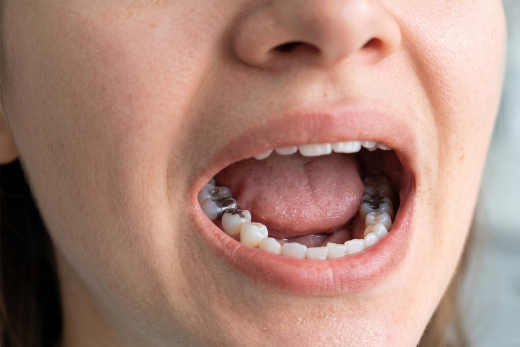 teeth amalgam fillings