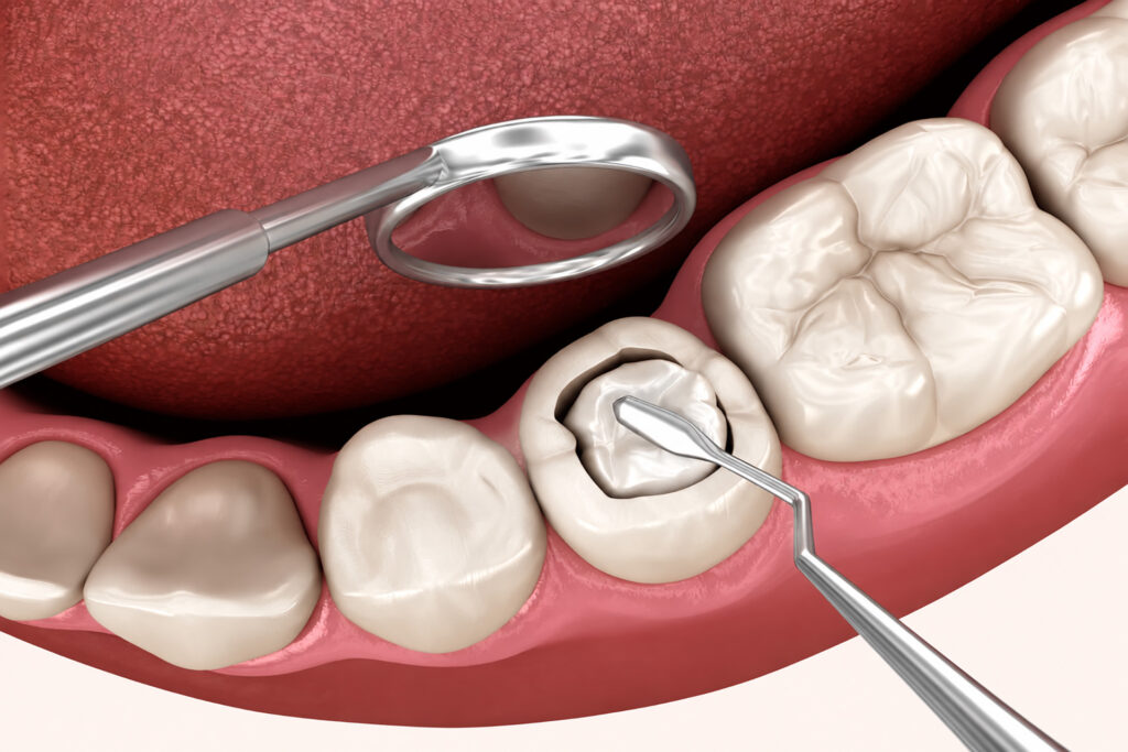 composite filling
