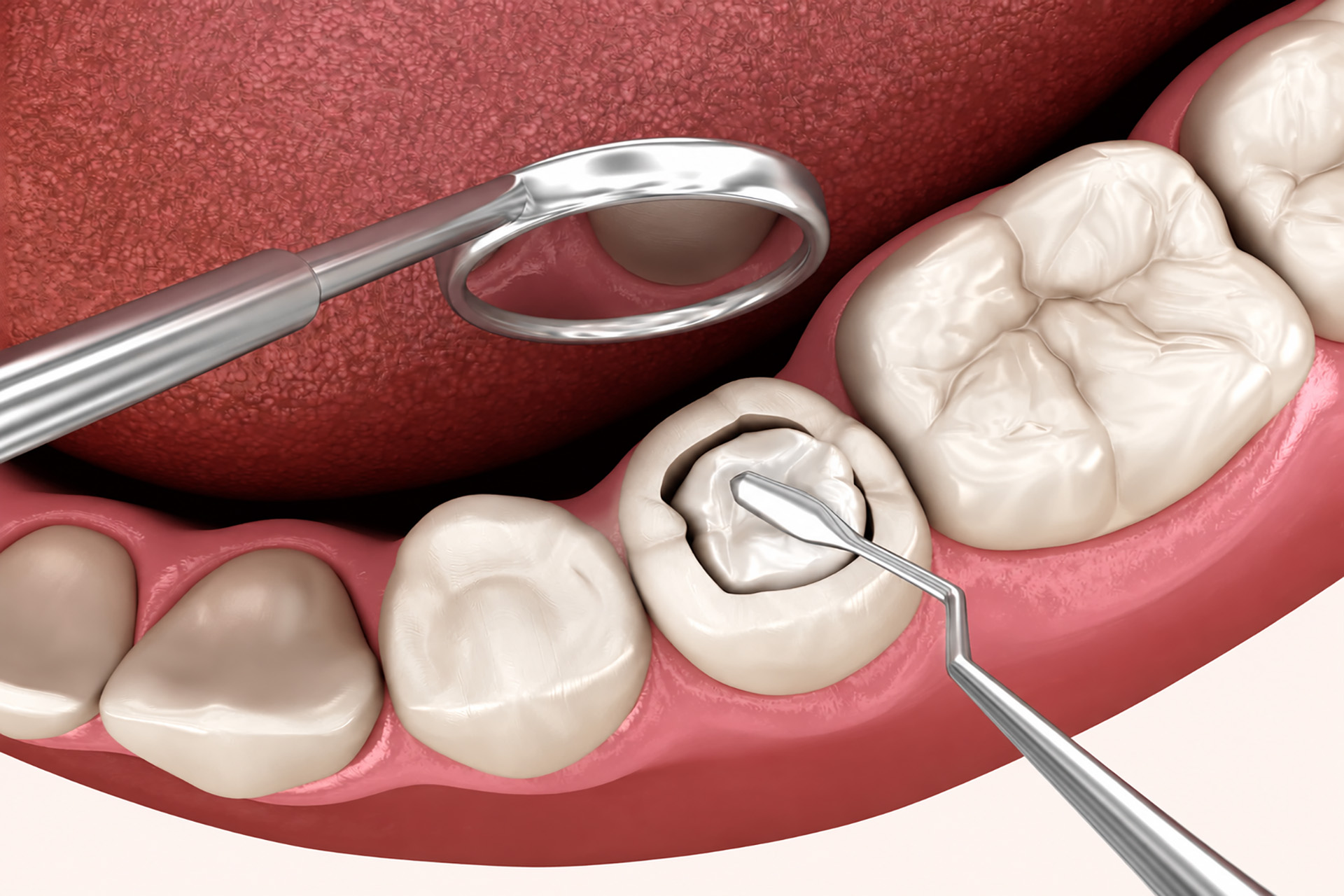 composite filling