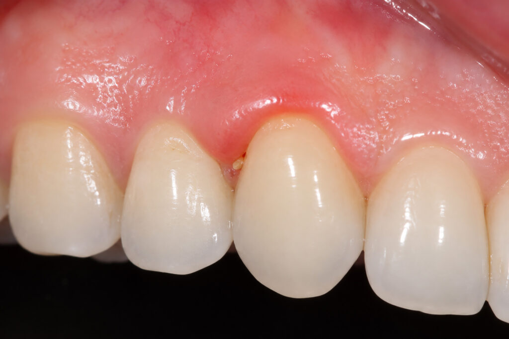 painful swollen gum around tooth