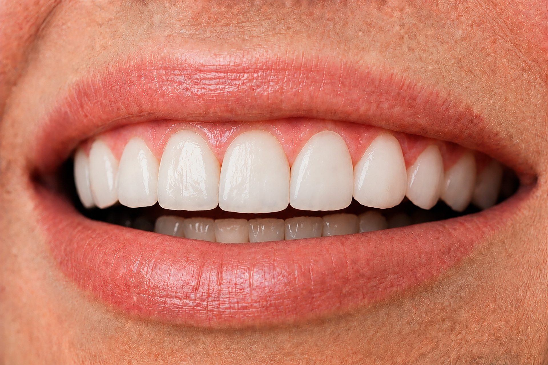 protruding teeth and excessive overjet