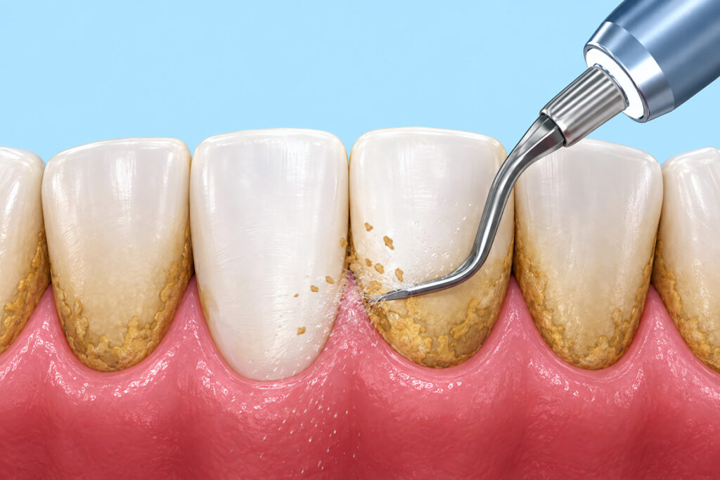 dental scaling and polishing